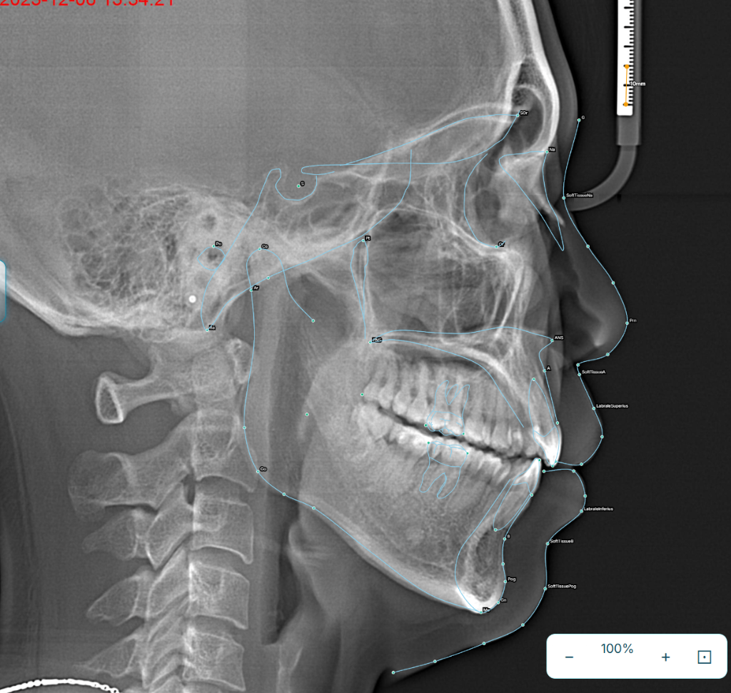 Lateral cephalogram with landmark tracing
